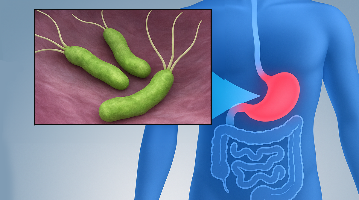 H. Pylori: Sintomas Mais Comuns e Como Identificar